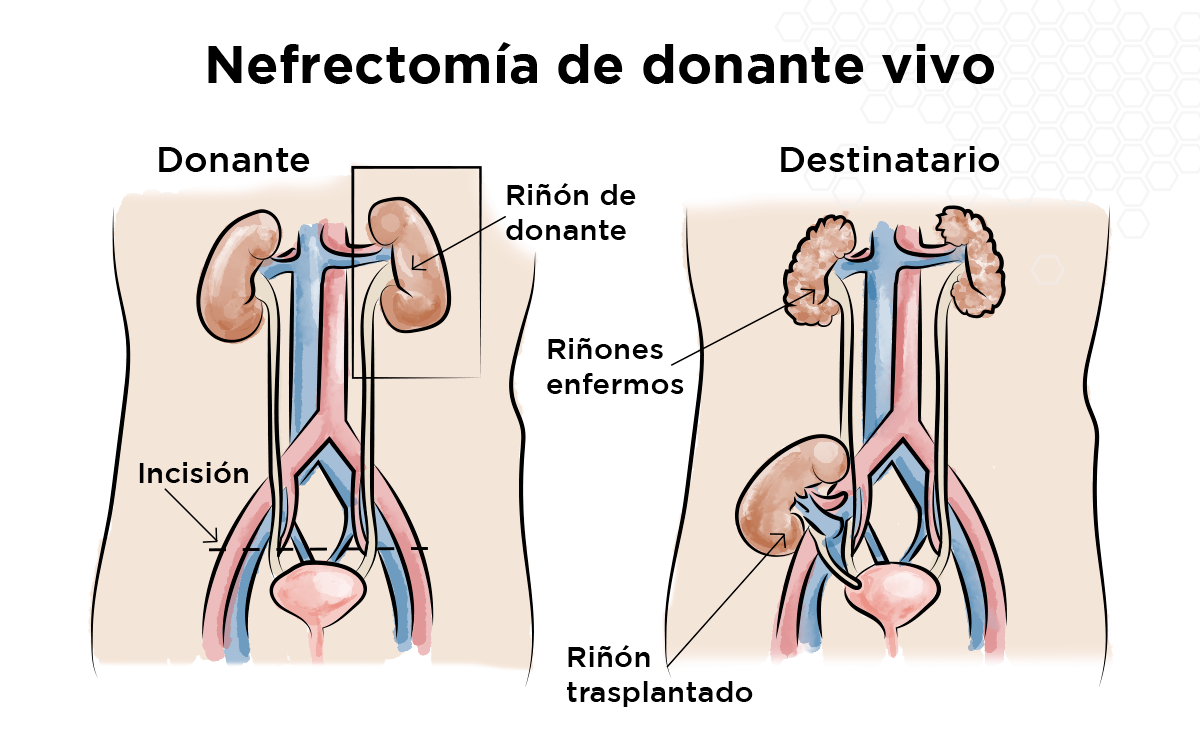 Nefrectomía de donante vivo